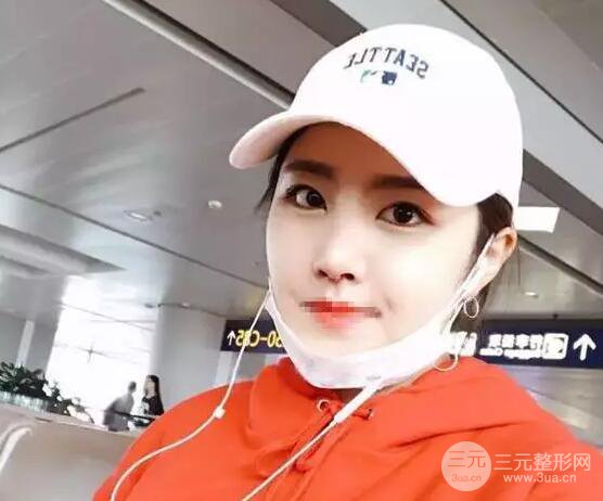 綜合隆鼻前后對(duì)比照片案例