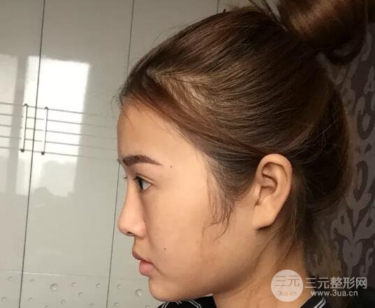 我的自體脂肪面部填充日記