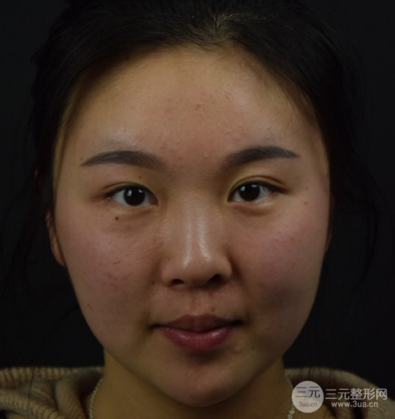 面部光纖溶脂三個月恢復記錄，妹子終于擺脫大臉盤子辣