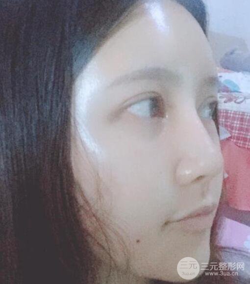 宜昌美岸醫(yī)療美容李英華自體脂肪面部填充怎么樣？真人日記曝光