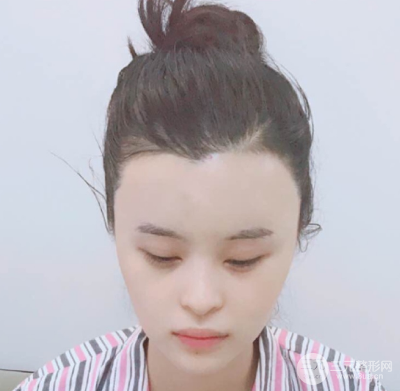 自體脂肪填充一個月真實恢復(fù)圖片，恢復(fù)后連閨蜜都驚艷辣