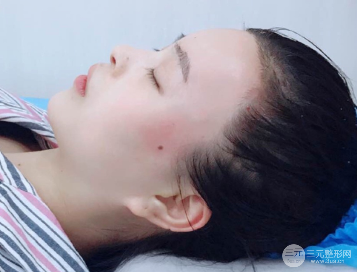 自體脂肪填充一個月真實恢復(fù)圖片，恢復(fù)后連閨蜜都驚艷辣