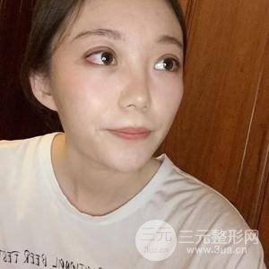 切開雙眼皮+上瞼下垂矯正術(shù)前術(shù)后果對比圖