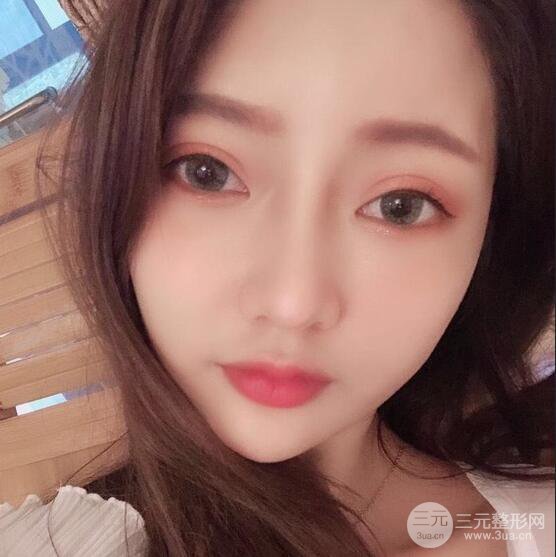 只是做了隆鼻整形改變居然辣么大，快來看看我的隆鼻整形恢復(fù)日記叭