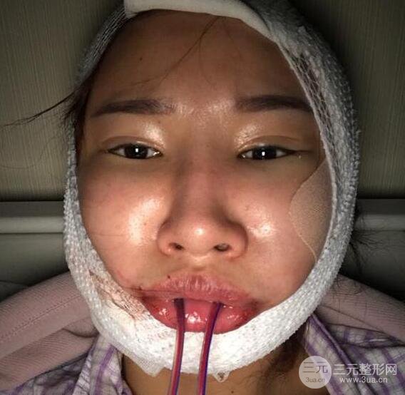 去下頜角+顴骨內(nèi)推手術(shù)三個(gè)月記錄，看大臉妹如何逆襲