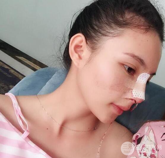 妹子做了隆鼻整形后竟變混血臉，來看看像baby還是娜扎