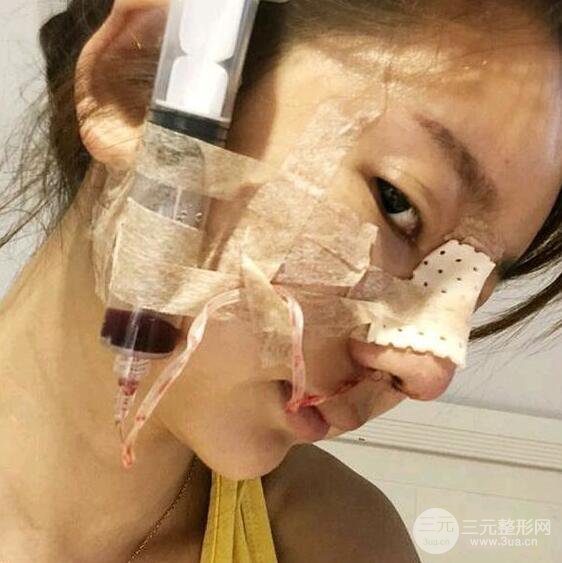 只是做了隆鼻整形改變居然辣么大，快來看看我的隆鼻整形恢復(fù)日記叭