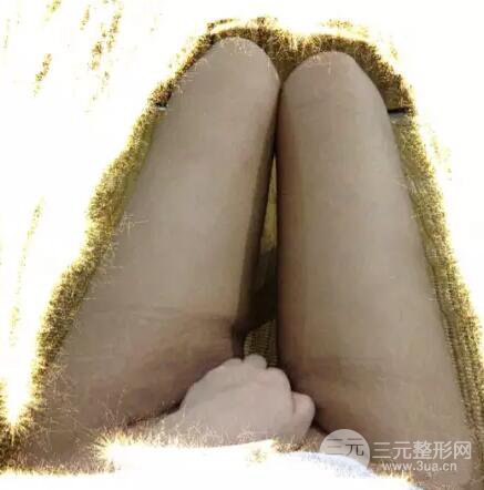 腿部吸脂親身經(jīng)歷