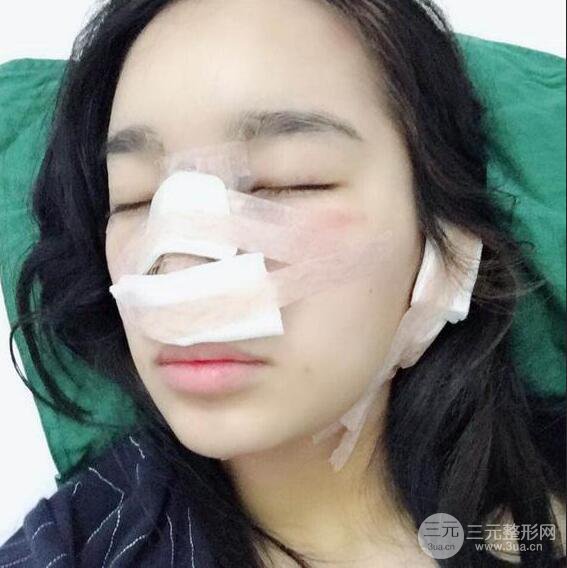 隆鼻整形術前術后對比照曝光，附經驗分享及心得體會