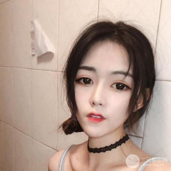 泉州億星醫(yī)療美容閔英俊切開雙眼皮果對(duì)比