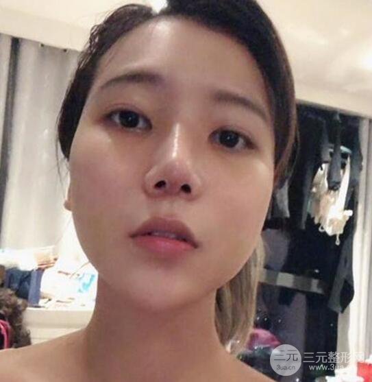 揚(yáng)州艾菲斯醫(yī)療美容張健隆鼻整形恢復(fù)記錄