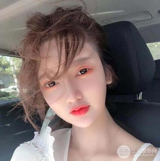 只是做了隆鼻整形改變居然辣么大，快來看看我的隆鼻整形恢復(fù)日記叭