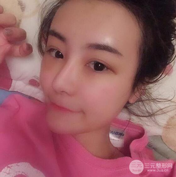 做了自體脂肪填充全臉，別人都以為我老公較為有錢