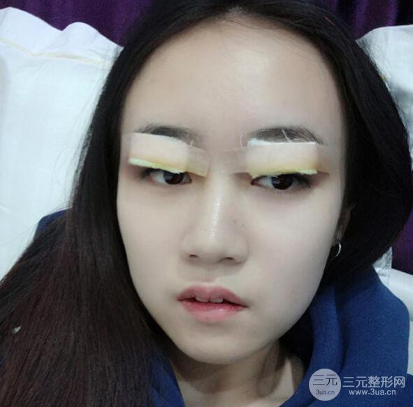 雙眼皮7mm一年后照片