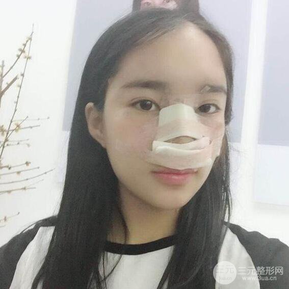 隆鼻整形術前術后對比照曝光，附經驗分享及心得體會