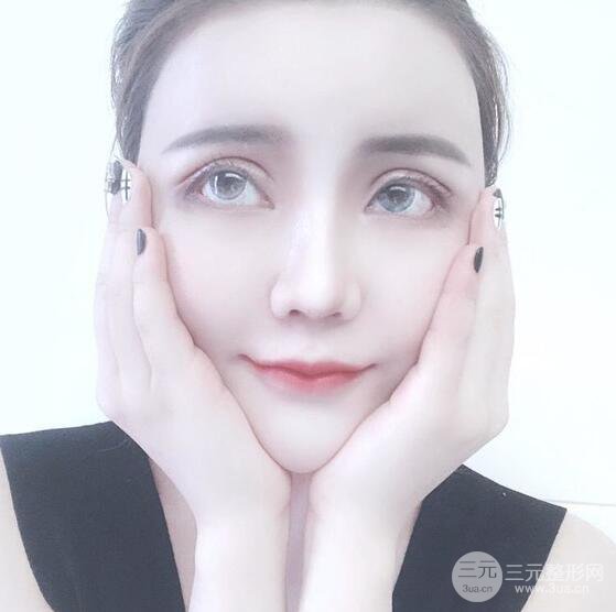 原來我和baby的距離只差一個網(wǎng)紅套餐，“雙眼皮+自體脂肪填充+豐唇”術(shù)后真人反饋