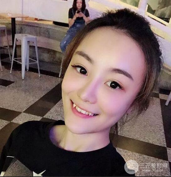 做了自體脂肪填充全臉，別人都以為我老公較為有錢