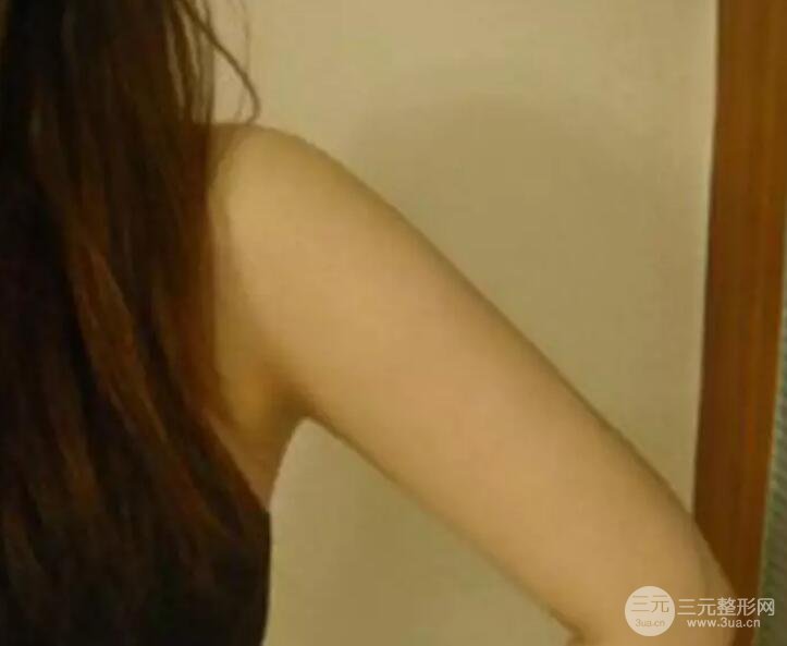 抽手臂脂肪的恢復(fù)過程