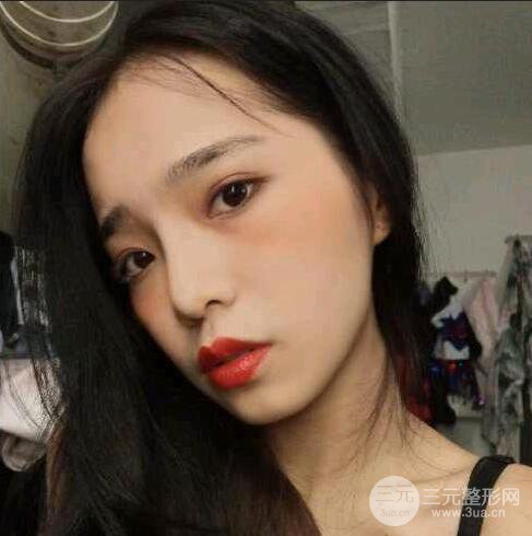 隆鼻整形術前術后對比照曝光，附經驗分享及心得體會