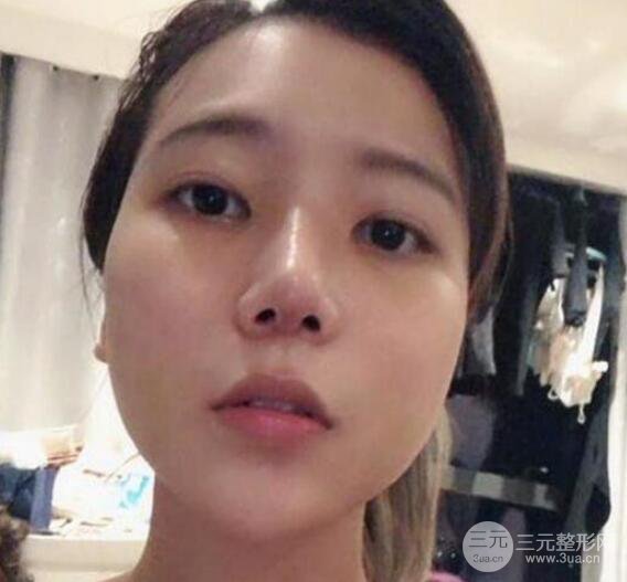 隆鼻整形手術三個月后真人果圖