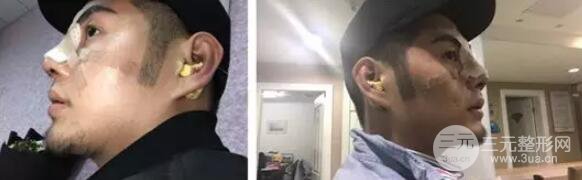 硅膠隆鼻一至7天恢復(fù)圖