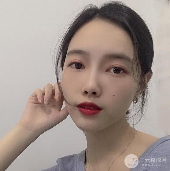 上海華美李健自體脂肪詳細(xì)部填充果圖，少女臉經(jīng)久不衰的秘密在這里