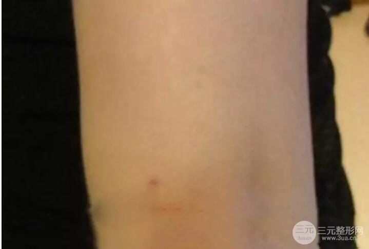 抽手臂脂肪的恢復(fù)過程