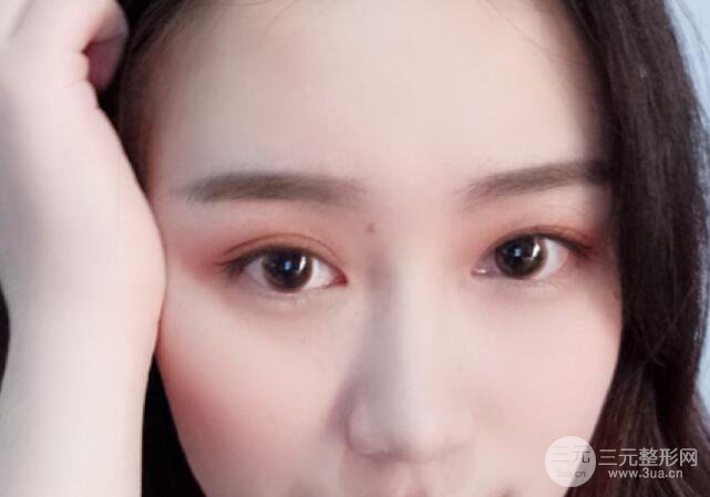 雙眼皮7mm一年后照片