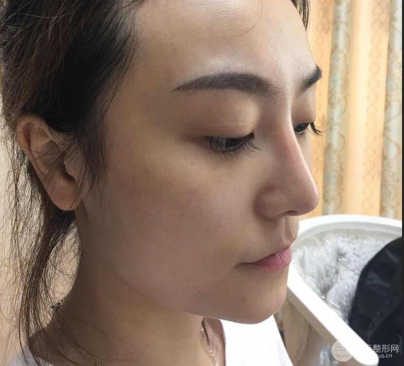 做了自體脂肪填充全臉，別人都以為我老公較為有錢