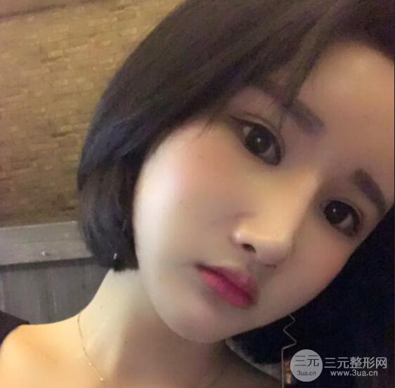 去下頜角+顴骨內(nèi)推手術(shù)三個(gè)月記錄，看大臉妹如何逆襲
