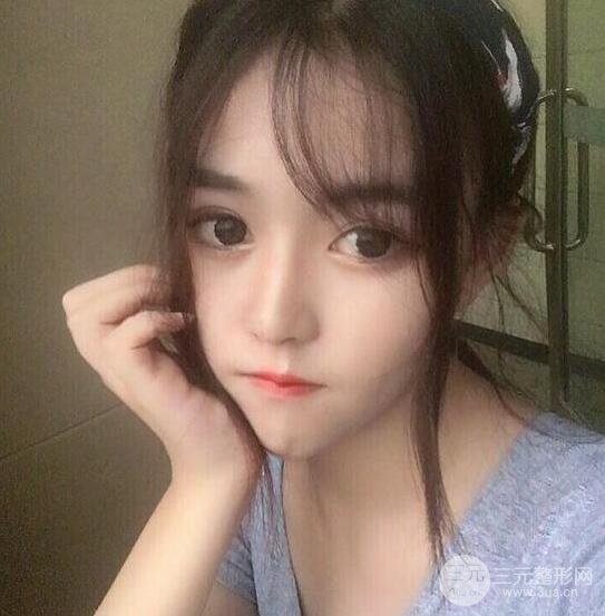 泉州億星醫(yī)療美容閔英俊切開雙眼皮果對(duì)比