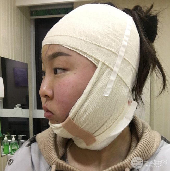 面部光纖溶脂三個月恢復記錄，妹子終于擺脫大臉盤子辣