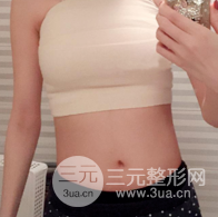 自體脂肪隆胸恢復(fù)圖曝光，見證從A到C的蛻變