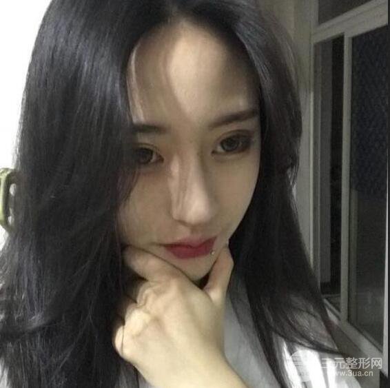 河南中醫(yī)藥大學(xué)第(一)附屬醫(yī)院趙絳波削下頜角恢復(fù)對(duì)比圖