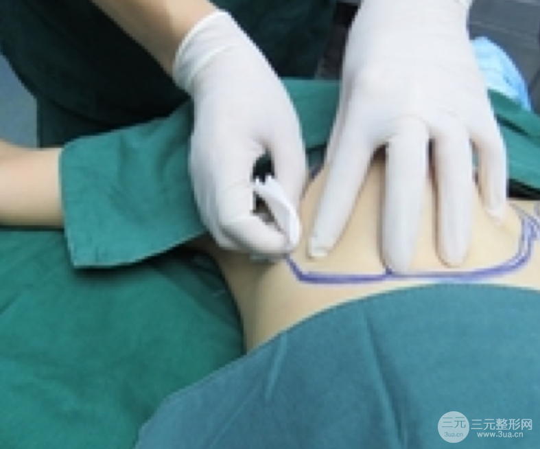 自體脂肪隆胸恢復(fù)圖曝光，見證從A到C的蛻變