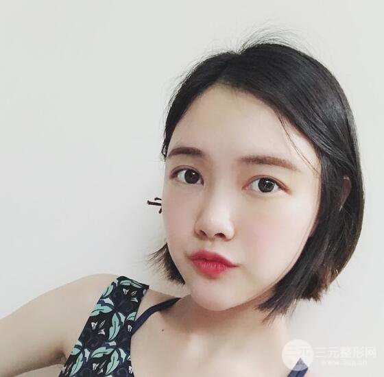 上海華美李健自體脂肪詳細(xì)部填充果圖，少女臉經(jīng)久不衰的秘密在這里