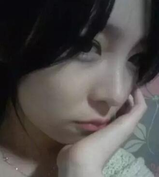 我的假體隆鼻恢復(fù)過(guò)程,有圖有真相哦~