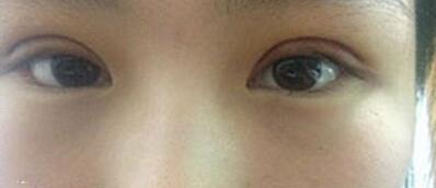 全切雙眼皮十天啦~來看看我的果