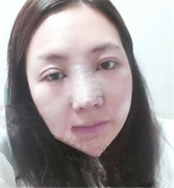 米揚(yáng)麗格巫文云做的鼻部修復(fù)，恢復(fù)得不錯(cuò)了