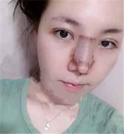 米揚(yáng)麗格巫文云做的鼻部修復(fù)，恢復(fù)得不錯(cuò)了