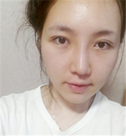 米揚(yáng)麗格巫文云做的鼻部修復(fù)，恢復(fù)得不錯(cuò)了