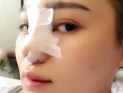 四川嬌點(diǎn)整形醫(yī)院的姜宇祿院長(zhǎng)給我做的隆鼻整形，分享給大家看看