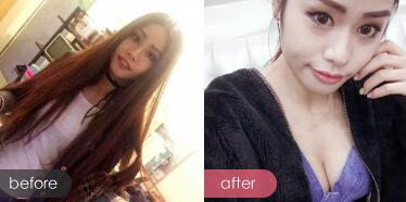 自體脂肪隆胸對比圖，四川嬌點(diǎn)醫(yī)學(xué)美容醫(yī)院的姜宇祿院長那里做自體脂肪豐胸手術(shù)