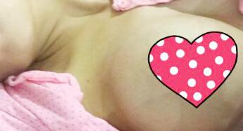 我自體脂肪隆胸手術(shù)后第(一)天的照片，9880元