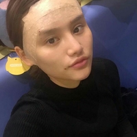 美圣美醫(yī)院任志偉為我做的自體脂肪面部填充恢復(fù)過程