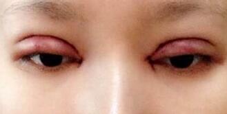 全切雙眼皮+去皮去脂+開眼角一個(gè)月了~