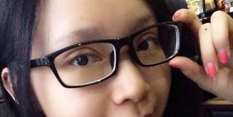 全切雙眼皮+去皮去脂+開眼角一個(gè)月了~