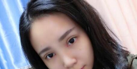 全切雙眼皮+去皮去脂+開眼角一個(gè)月了~