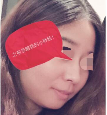 做了玻尿酸注射隆鼻 感覺(jué)很不錯(cuò)