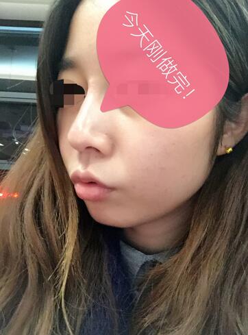 做了玻尿酸注射隆鼻 感覺(jué)很不錯(cuò)